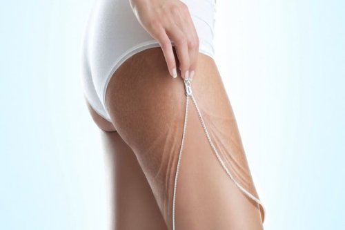 SELÜLİT TEDAVİSİ